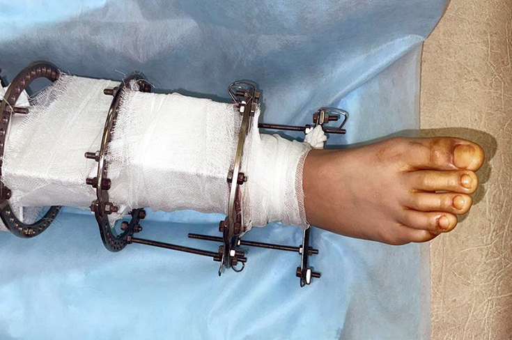 Врачи клиники доктора Рошаля спасли ногу подростка, которая попала в культиватор