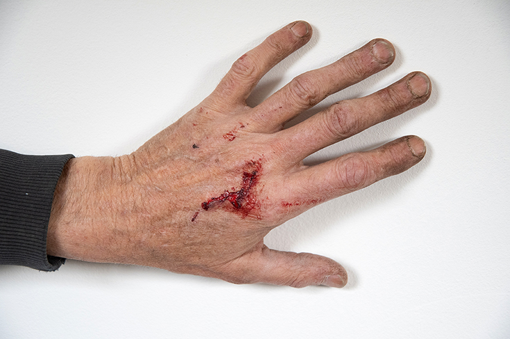 Московские врачи сохранили пациенту кисть, которую оторвало после попадания в бетононасос