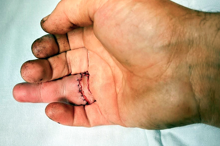 В ГКБ Ерамишанцева помогли мужчине, который чуть не лишился пальца из-за обручального кольца