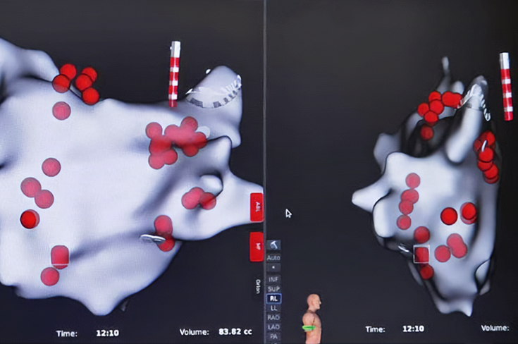 В Москве провели первые операции для лечения аритмии без кардиостимулятора