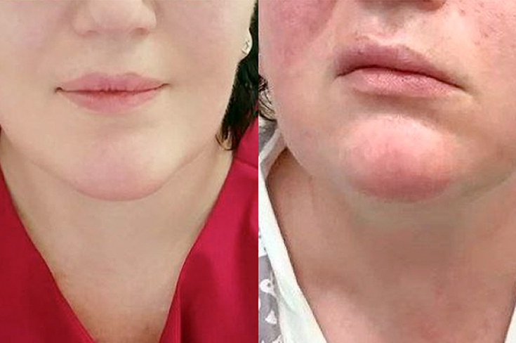 В Москве врачи помогли женщине с редким заболеванием, которое привело к параличу лица и снижению слуха