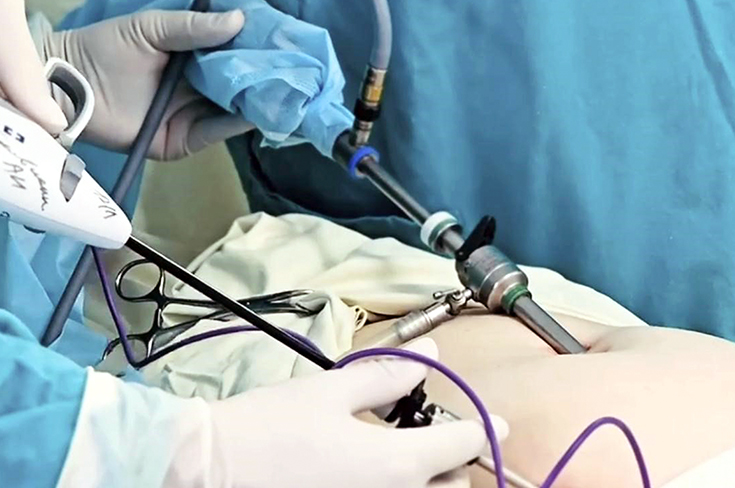 В Москве у женщины удалили кисту яичника объемом 5,5 литров