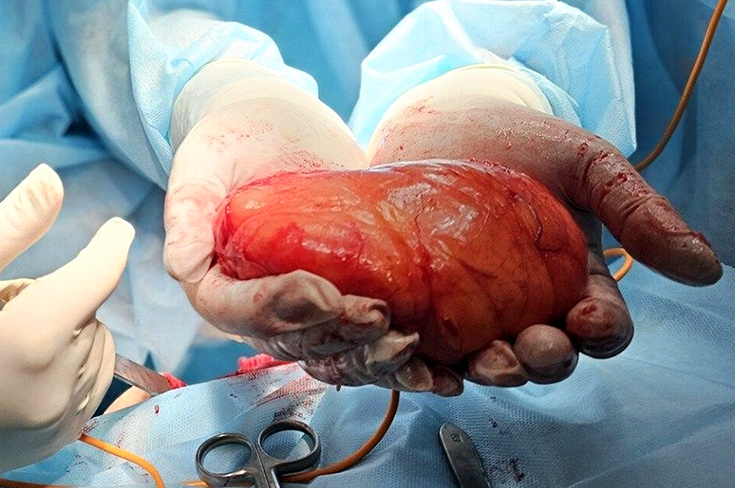 Хирурги ГКБ Кончаловского удалили липому, которая за 20 лет выросла до огромного размера